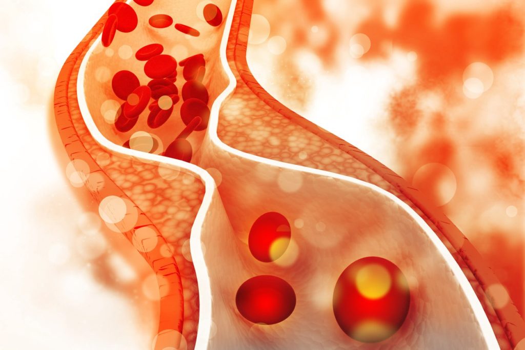 Double Vessel Disease: Understanding Your Treatment Options